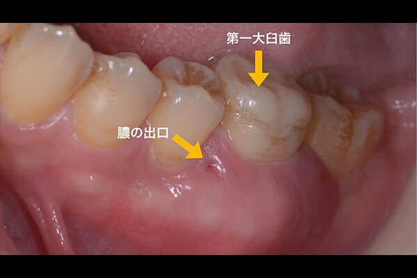 歯茎 膿