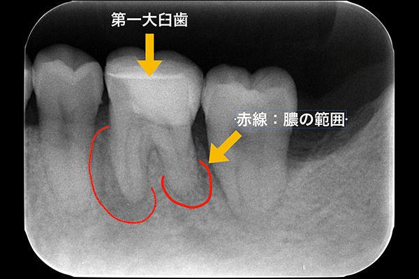 精密根管治療 症例 | 恵比寿ヘンミデンタルオフィス