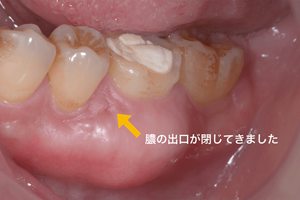 精密根管治療 症例 恵比寿ヘンミデンタルオフィス